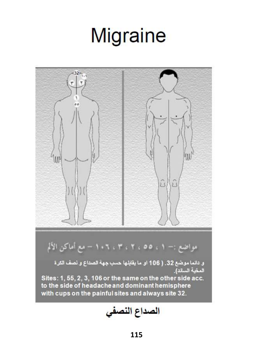 Hijama Atlas — page 115 — Migraines