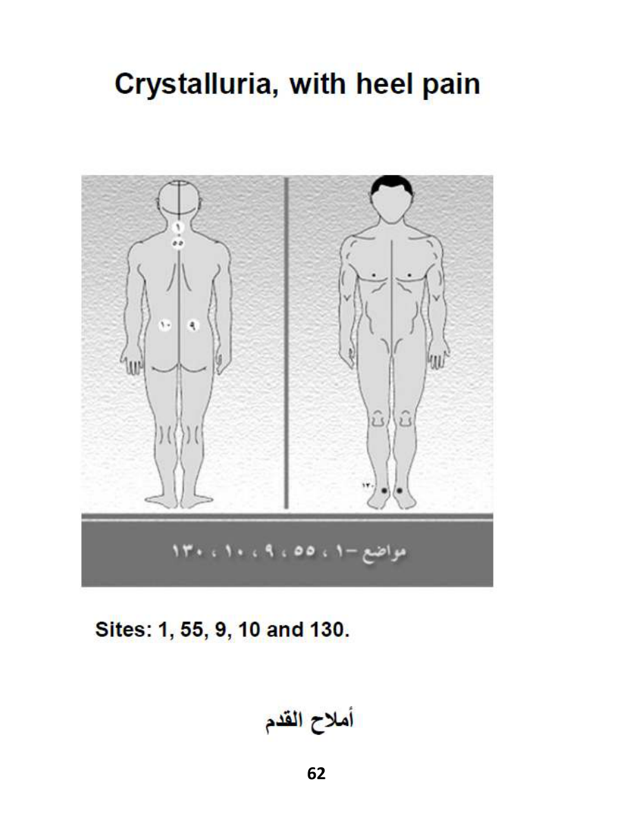 Hijama Atlas — page 62 — Plantar Fasciitis