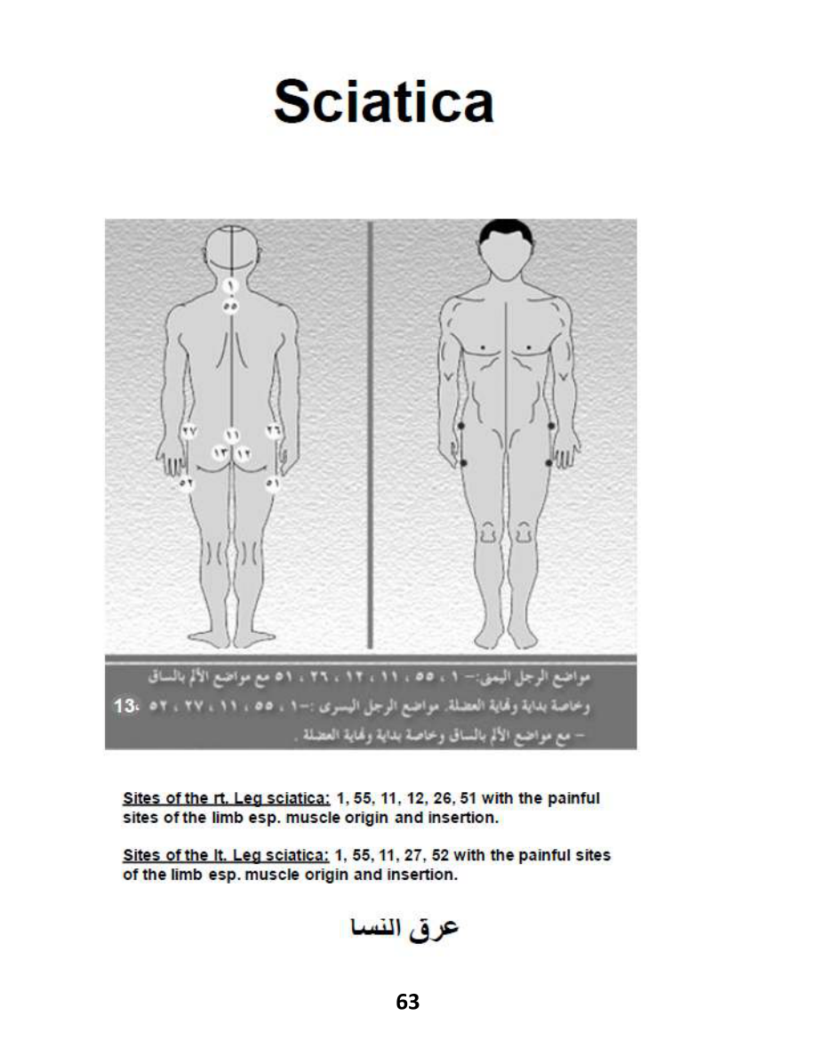 Hijama Atlas — page 63 — Sciatica (Irq an-Nisa)