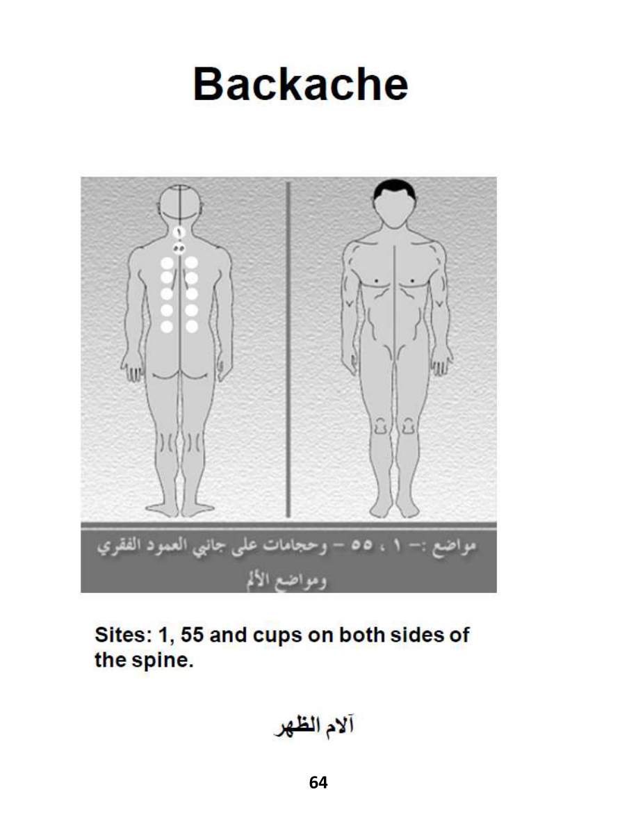 Hijama Atlas — page 64 — Herniated Disc