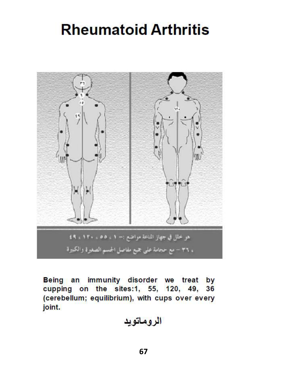 Hijama Atlas — page 67 — Fibromyalgia