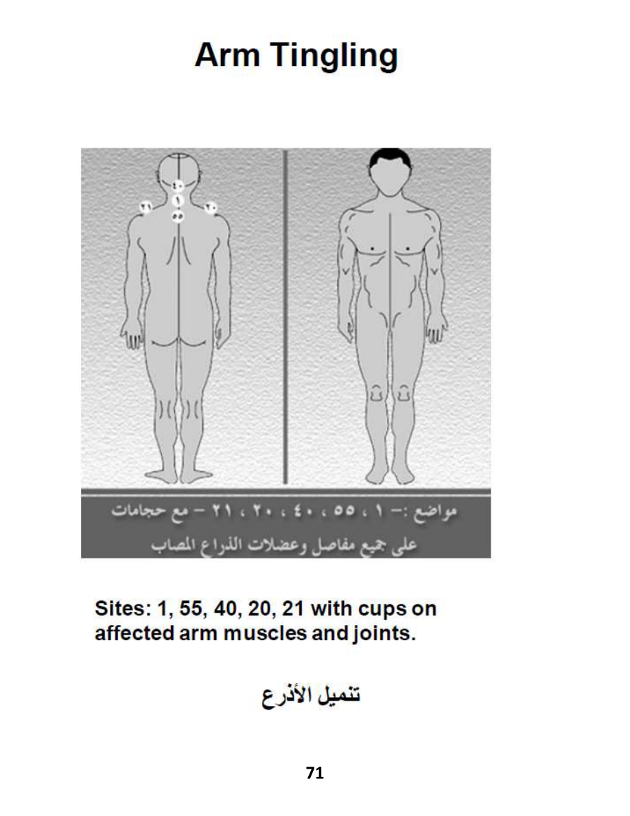 Hijama Atlas — page 71 — Carpal Tunnel Syndrome
