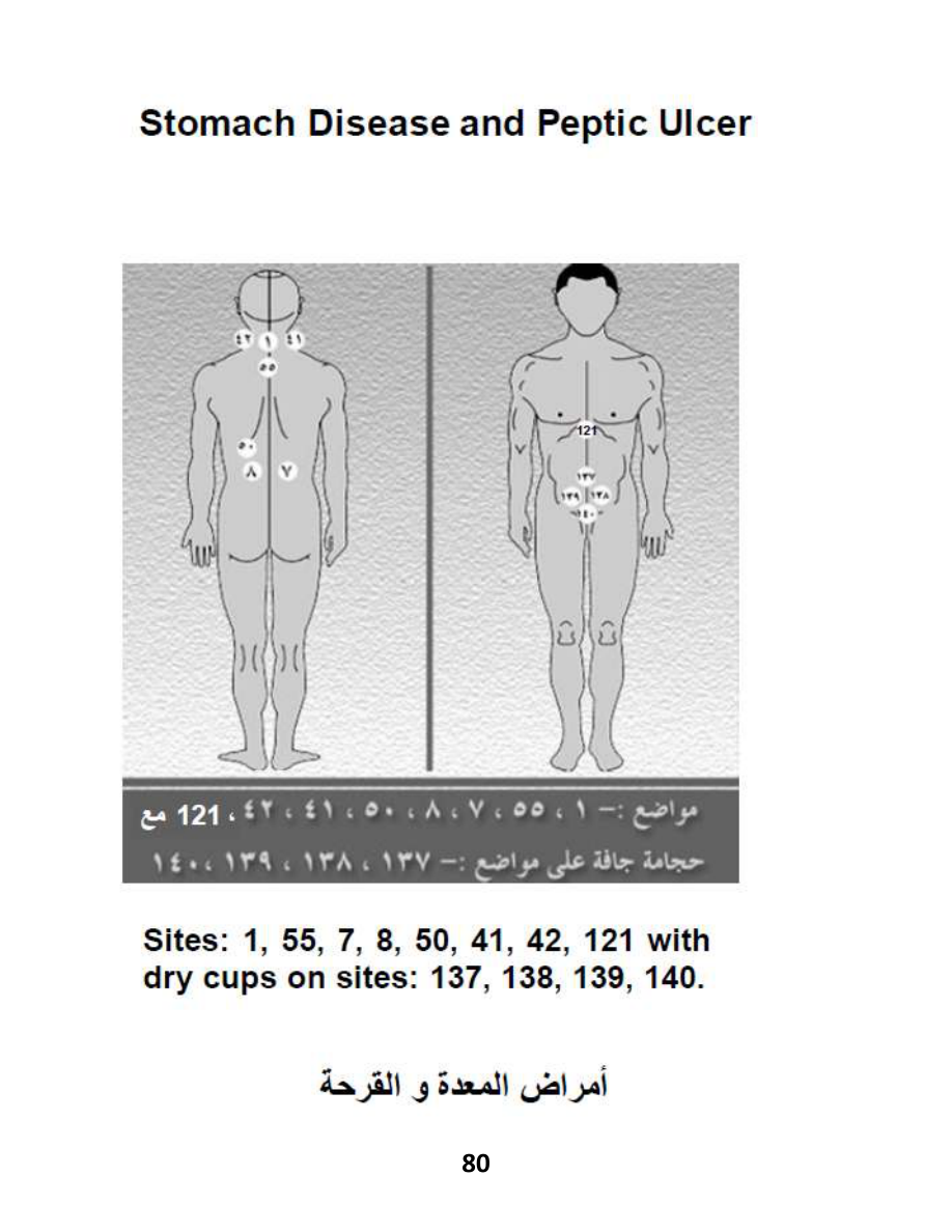 Hijama Atlas — page 80 — GERD (Acid Reflux)