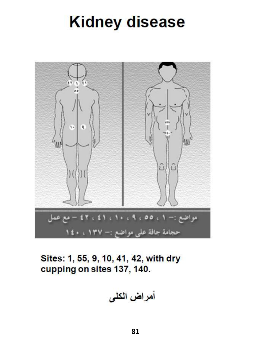 Hijama Atlas — page 81 — Kidney Stones