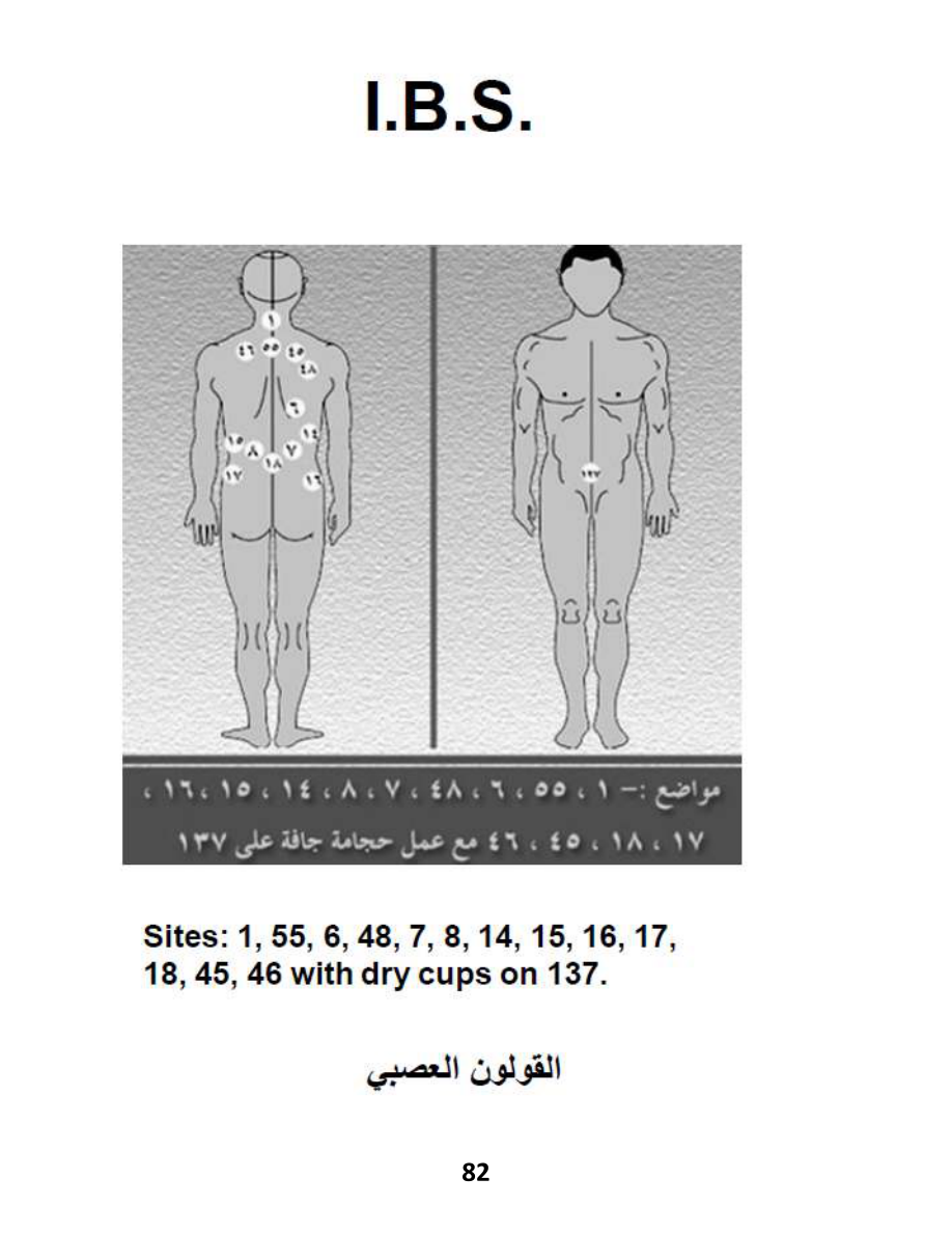 Hijama Atlas — page 82 — Colitis (Inflammatory)