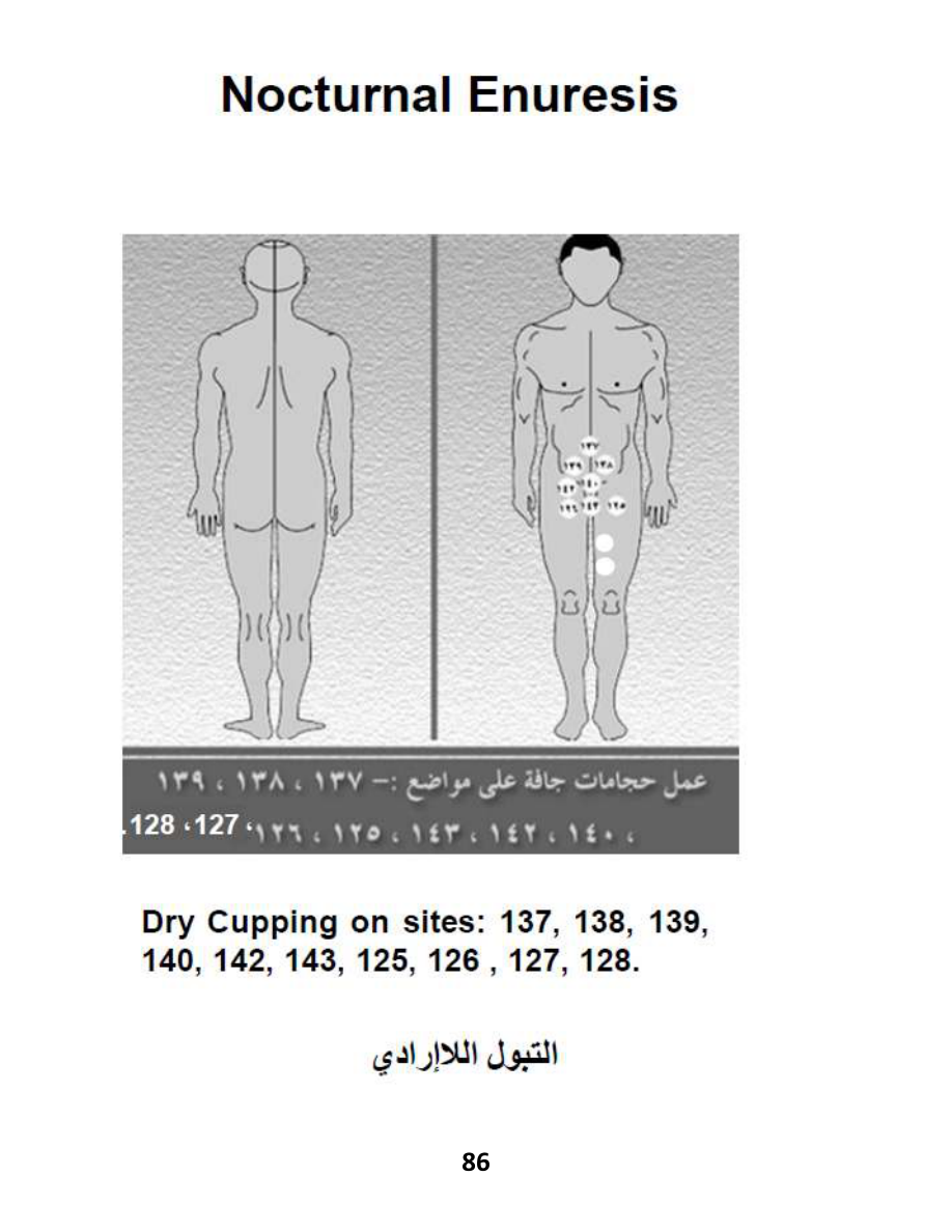 Hijama Atlas — page 86 — Bedwetting (Nocturnal Enuresis)