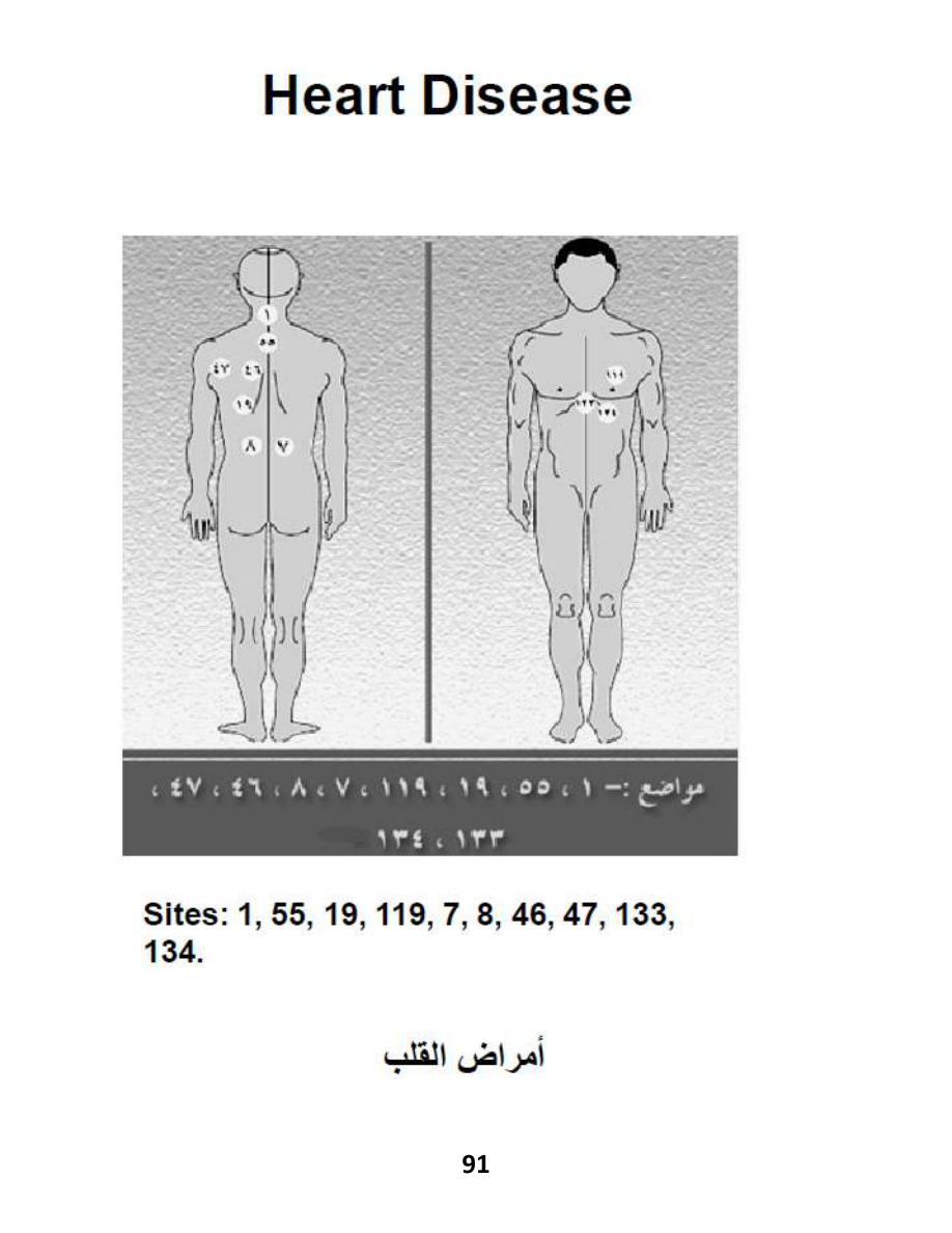 Hijama Atlas — page 91 — Heart Disease (Coronary Support)